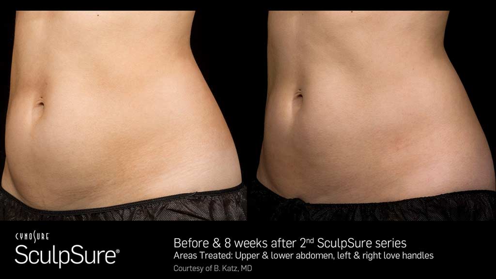 5 Reasons Why Body Sculpting with SculpSure Remains So Popular